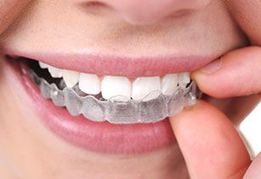 Best Braces in West Chicago Invisalign® teeth